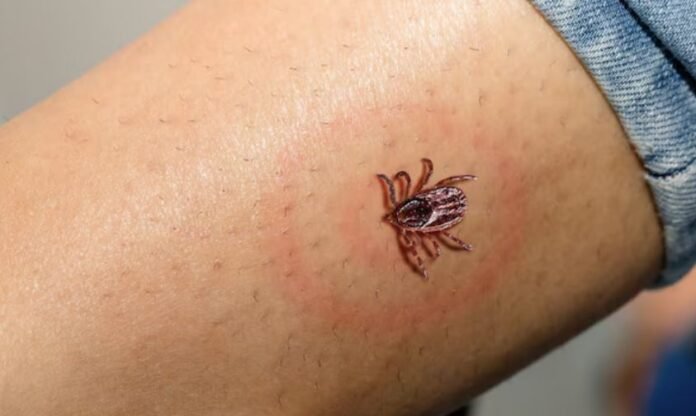 Lyme Disease Looks Like Burnout